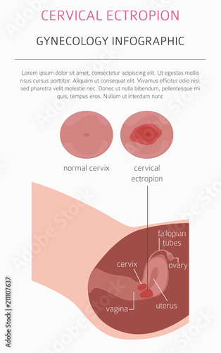 Cervical ectropion. Ginecological medical desease infographic