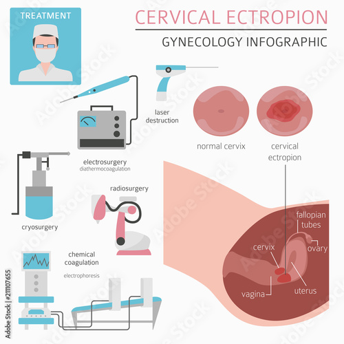 Cervical ectropion. Ginecological medical desease infographic