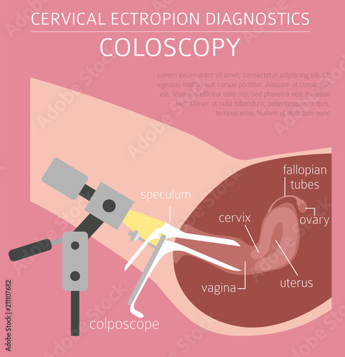Cervical ectropion. Ginecological medical desease infographic