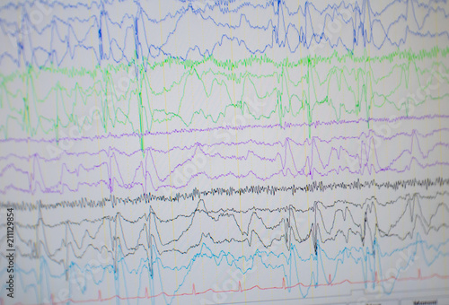 Computer monitor showing electrical activity of abnormal brain,EEG of the pediatric patients with problems in the brain.