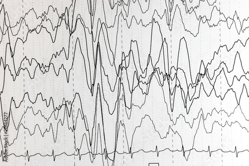 EEG of the pediatric patients  problems in the electrical activity of the brain.Abnormal EEG.