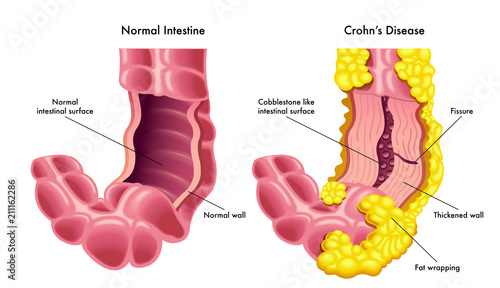 A vector medical illustration of a section of a normal intestine compared to a section of intestine with the symptoms of the Crohn's disease.