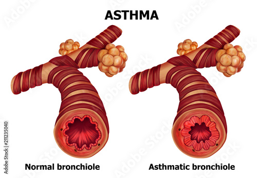 Anatomy of Asthma