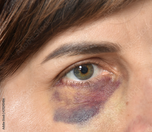 Close up of woman with bruise on her face