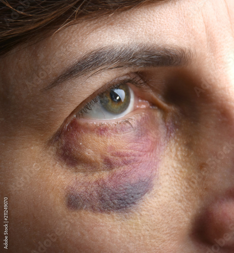 Obraz na płótnie Close up of woman with bruise on her face w salonie