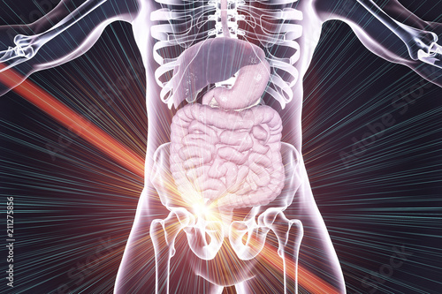 Laser surgery treatment of acute appendicitis, conceptual image, 3D illustration. Appendectomy photo