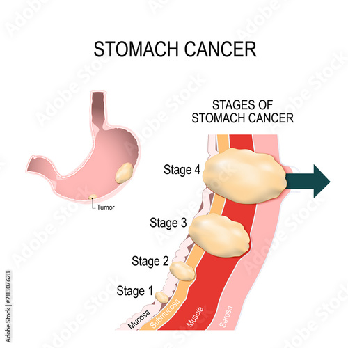 stomach cancer photo