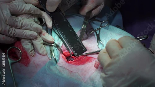 Surgery. The doctor's hands measure the cut with a ruler photo