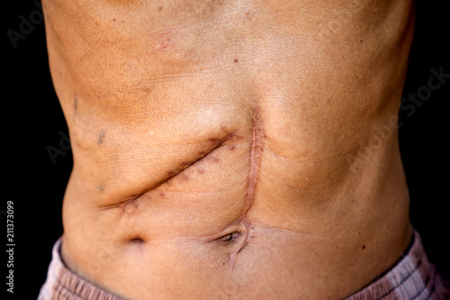 Scars caused by abdominal surgery.