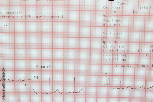 Electrocardiogram of wave in paper report analysis. Medical and healthcare concept.