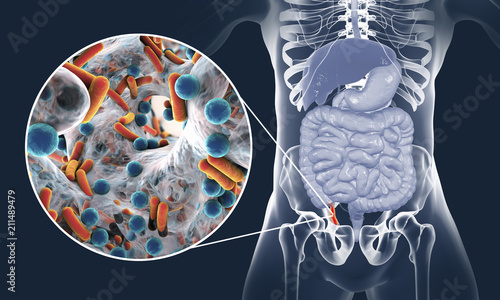 Acute appendicitis and close-up view of bacteria in appendix, the causative agent of appendicitis, 3D illustration photo