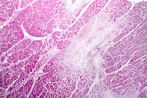 Schilderij op canvas Acute myocardial infarction, histology of heart tissue, light micrograph