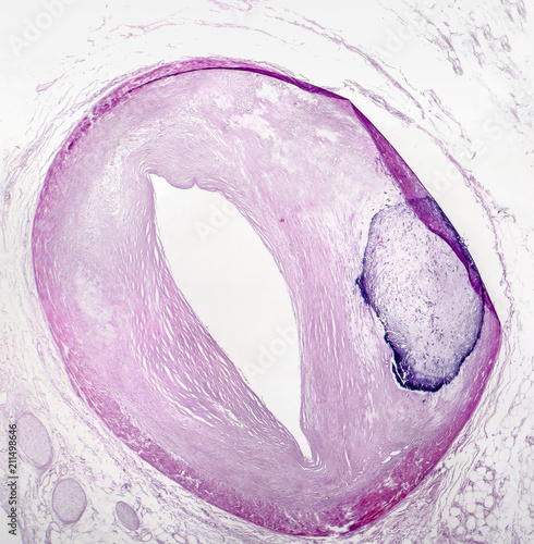 Vascular calcification, light micrograph, hematoxylin and eosin staining photo