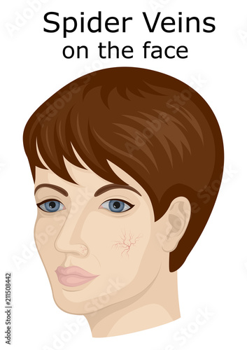 Illustration of the facial spider veins