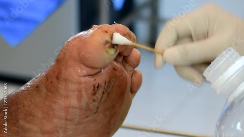 cleaning infected wound on foot  photo