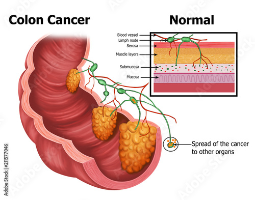 colon-cancer