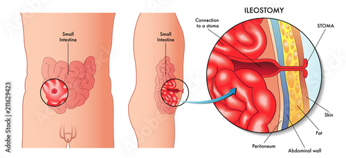vector medical illustration of an operation of ileostomy photo