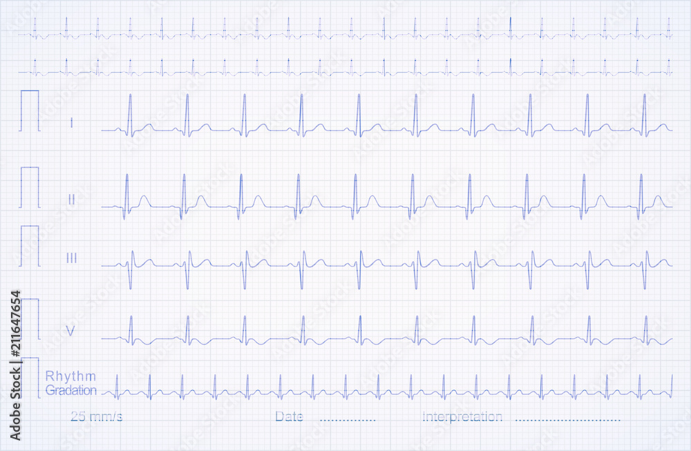 ECG pattern on the linear graph paper, vector illustration