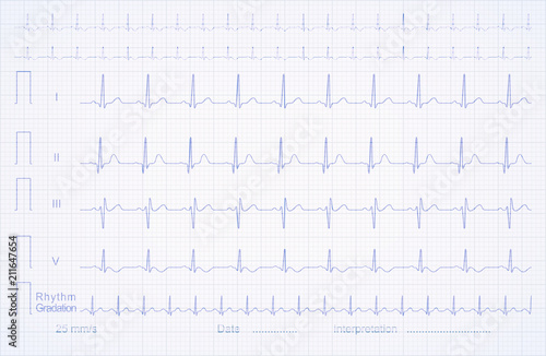 ECG pattern on the linear graph paper, vector illustration