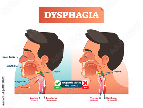 Vector illustration about dysphagia and compered it in scheme. Close-up human with nasal cavity, mouth, tongue, epiglottis, larynx, food, trachea and esophagus. photo