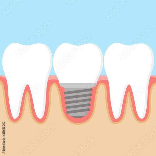 Row of teeth with dental implant . Dental prosthetics. Vector illustration