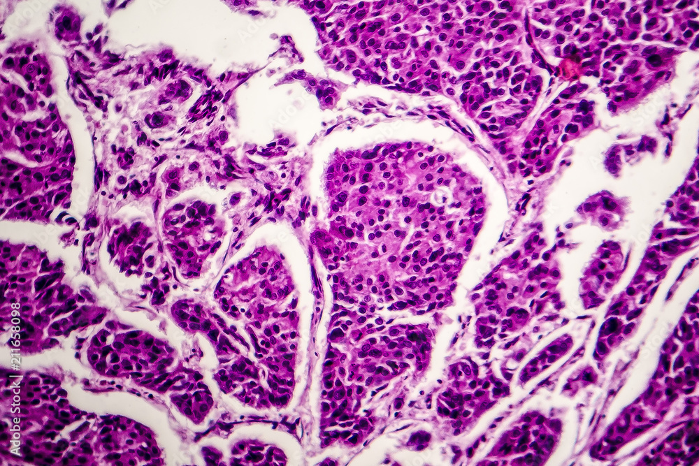 Lymph node metastasis, light micrograph of cancer that has spread to a