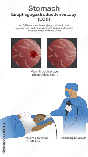 Esophagogastroduodenoscopy EGD is a test to examine the lining of the esophagus, stomach, and first part of the small intestine.