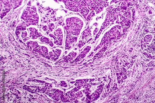 Foto Lymph node metastasis, light micrograph of cancer that has spread to a lymph nod