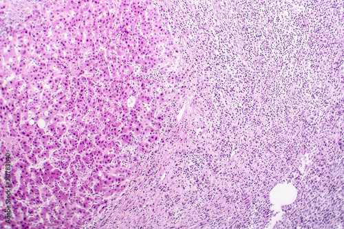 Histopathology of liver abscess, light micrograph, hematoxylin and eosin staining photo