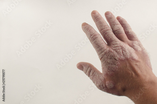 Exacerbation of psoriasis in the hands. Concept of health photo
