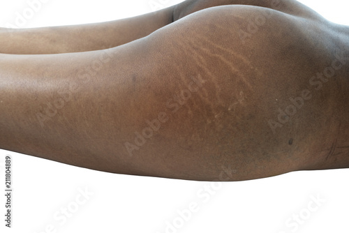 Portrait of young woman having skin complexion problems and stretch marks isolated on white background