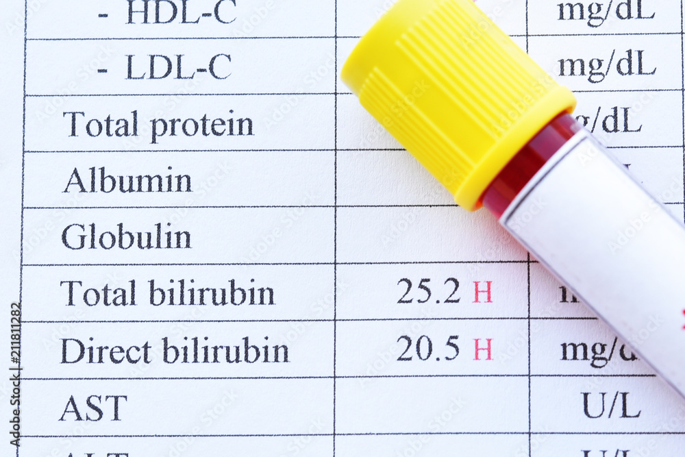 Abnormal high bilirubin test result with blood sample tube Stock Photo ...