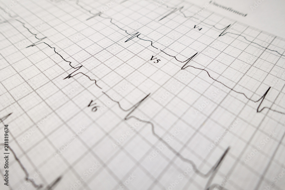 heart test ekg printed graph sheet heart test ekg printed graph sheet