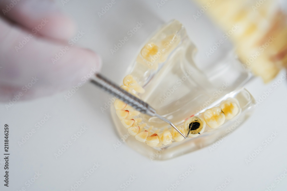 doctor orthodontist shows the instrument on caries in the teeth doctor orthodontist shows the instrument on caries in the teeth