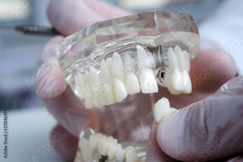 the orthodontist holds a model of teeth with implants in his hand and shows how to insert the tooth. Close up. Macro