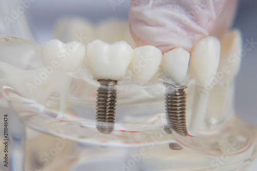Orthodontist shows how to insert the implant. Macro