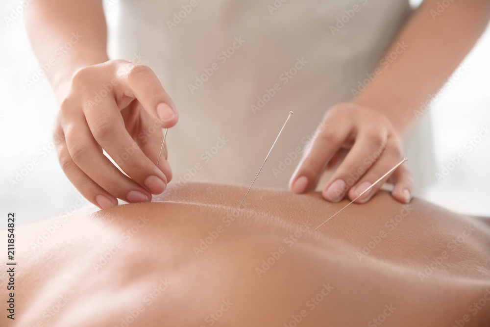 Young man undergoing acupuncture treatment in salon, closeup - obrazy, fototapety, plakaty 