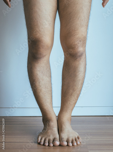 Asian man leg bandy-legged shape of the legs