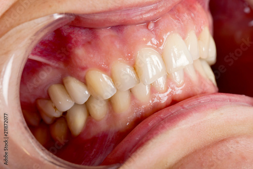 Tablou pe pânză Cheek retractor close up