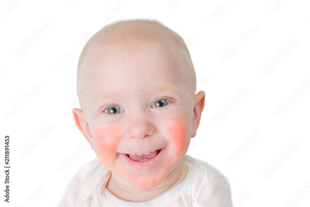 Food allergy concept - baby with dermatitis on cheeks