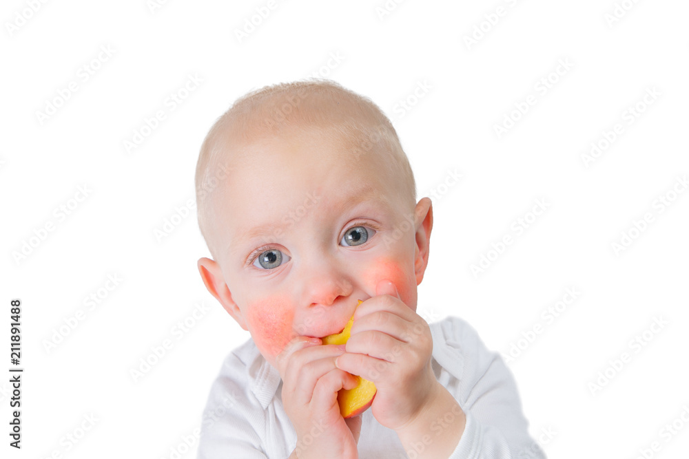 Food allergy concept - baby with dermatitis on cheeks Food allergy concept - baby with dermatitis on cheeks