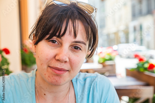 Papier peint woman portrait with acne on face.