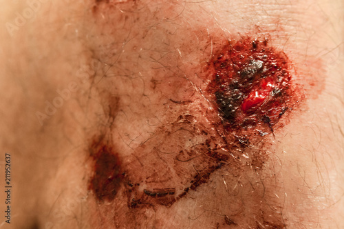 Canvas Print Flesh wound with blood on male foot closeup