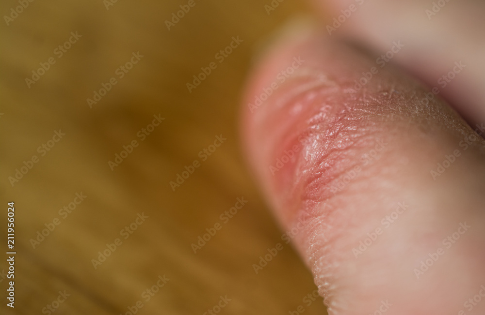 Fototapeta premium the foot callus suffering