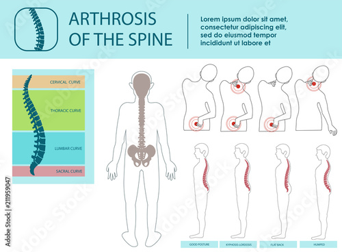 Arthrosis of Spine. Vector Illustration.