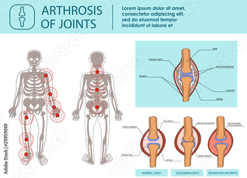 Arthrosis of Joints. Vector Illustration.