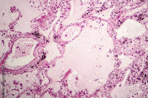 Histopathology of acute pulmonary edema, light micrograph showing accumulation of fluid inside alveoli photo
