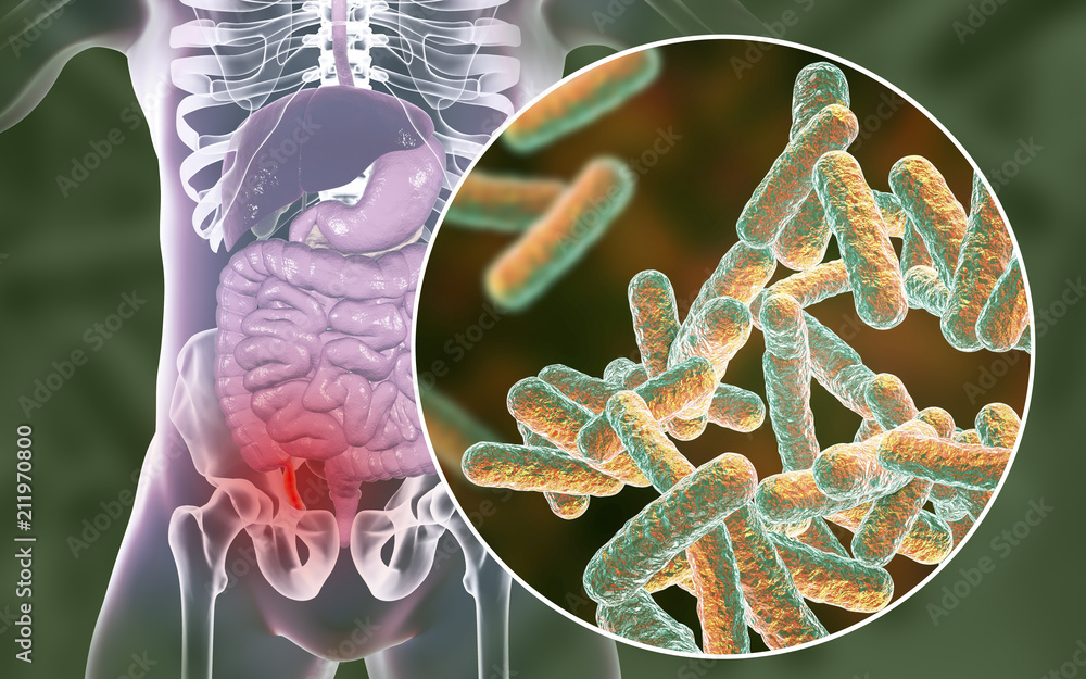 Acute appendicitis and closeup view of bacteria in appendix, the
