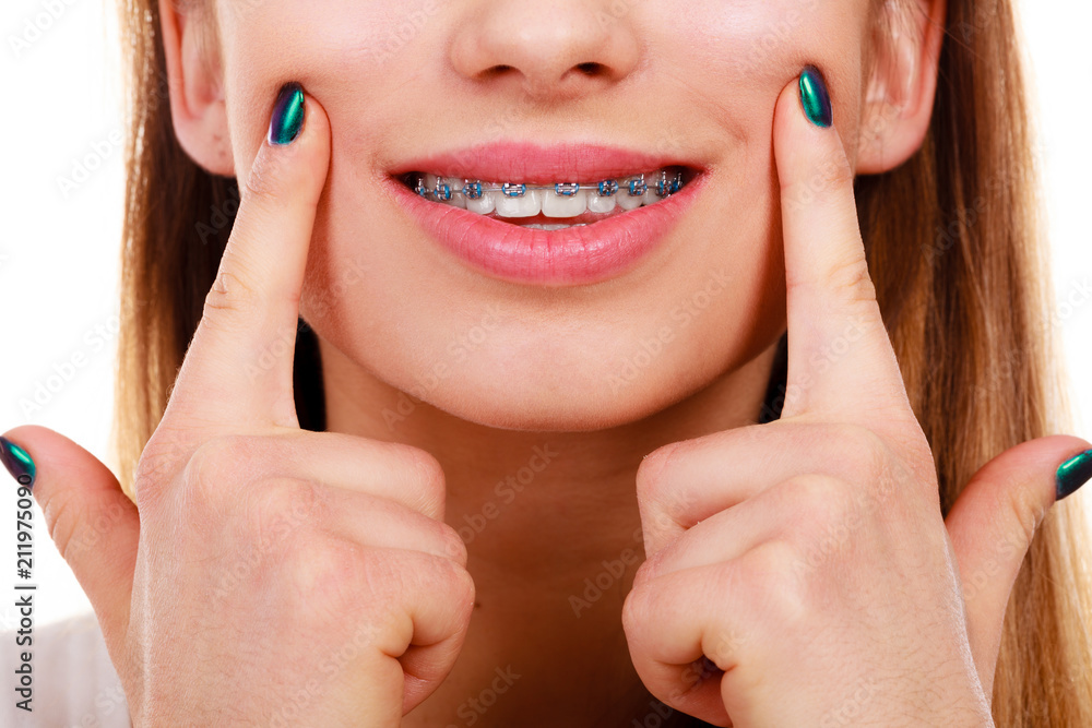 Obraz premium Woman showing her teeth with braces
