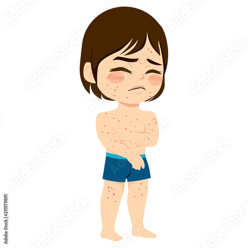 Cute sad little boy with small itchy blisters symptom ill with measles chicken pox pimples illness scratching arm